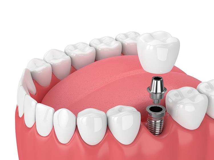 Why should we buy made in China dental implants?