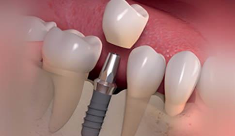 Dental Implants Manufacturers in China