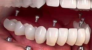 How Long Does a Titanium Dental Implant Last?