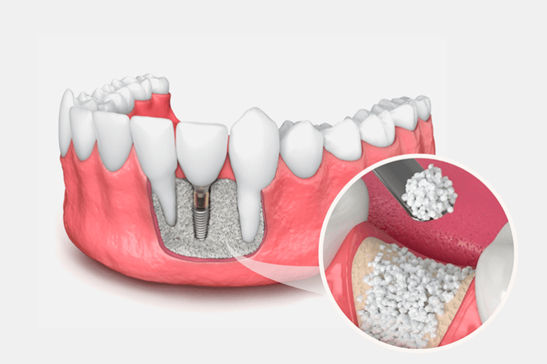 Dental Bone Grafts