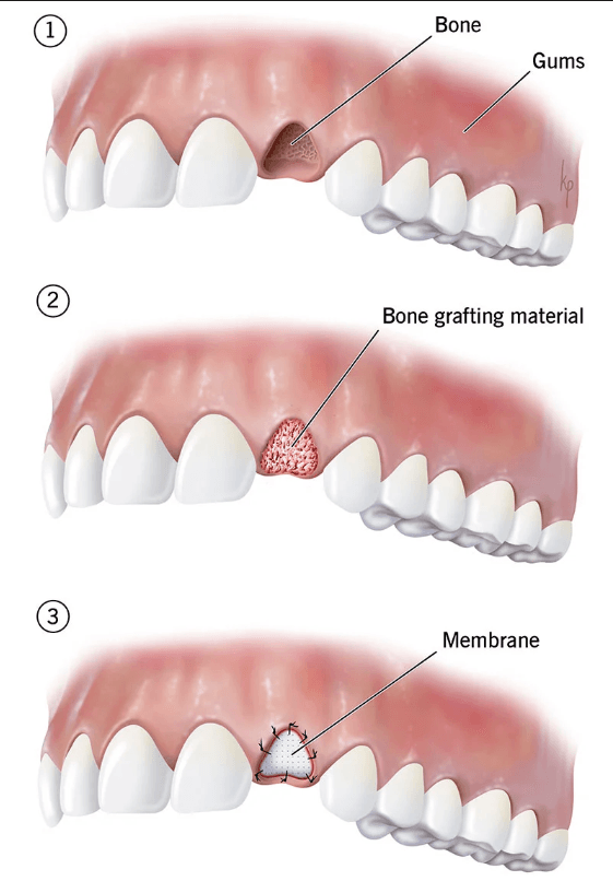 Dental Bone Grafts Dental Bone Grafts