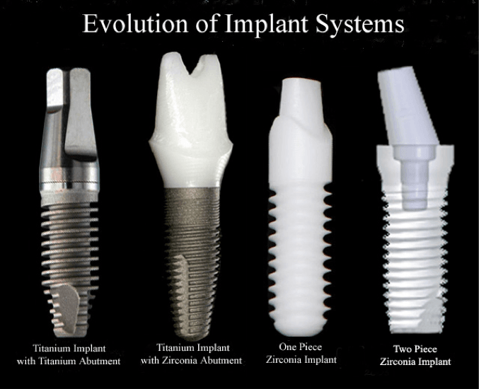 Evolution of Implant Systems Evolution of Implant Systems