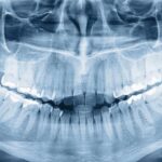 How Much Are Dental X Rays Without Insurance