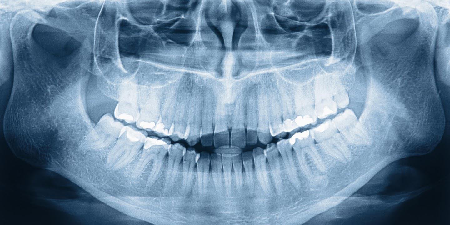 How Much Are Dental X Rays Without Insurance