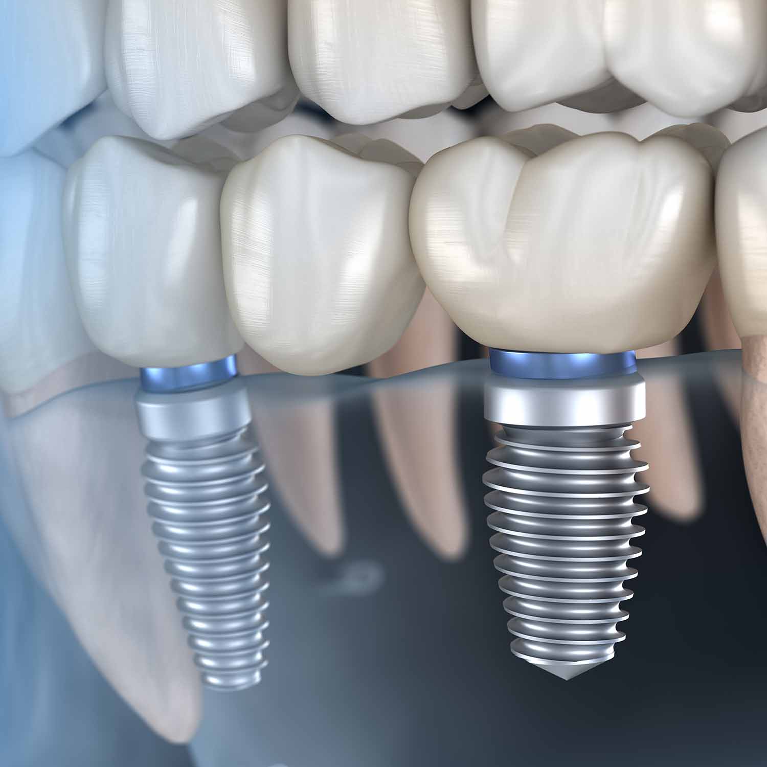 Risks and Considerations of Dental Implant Surgery