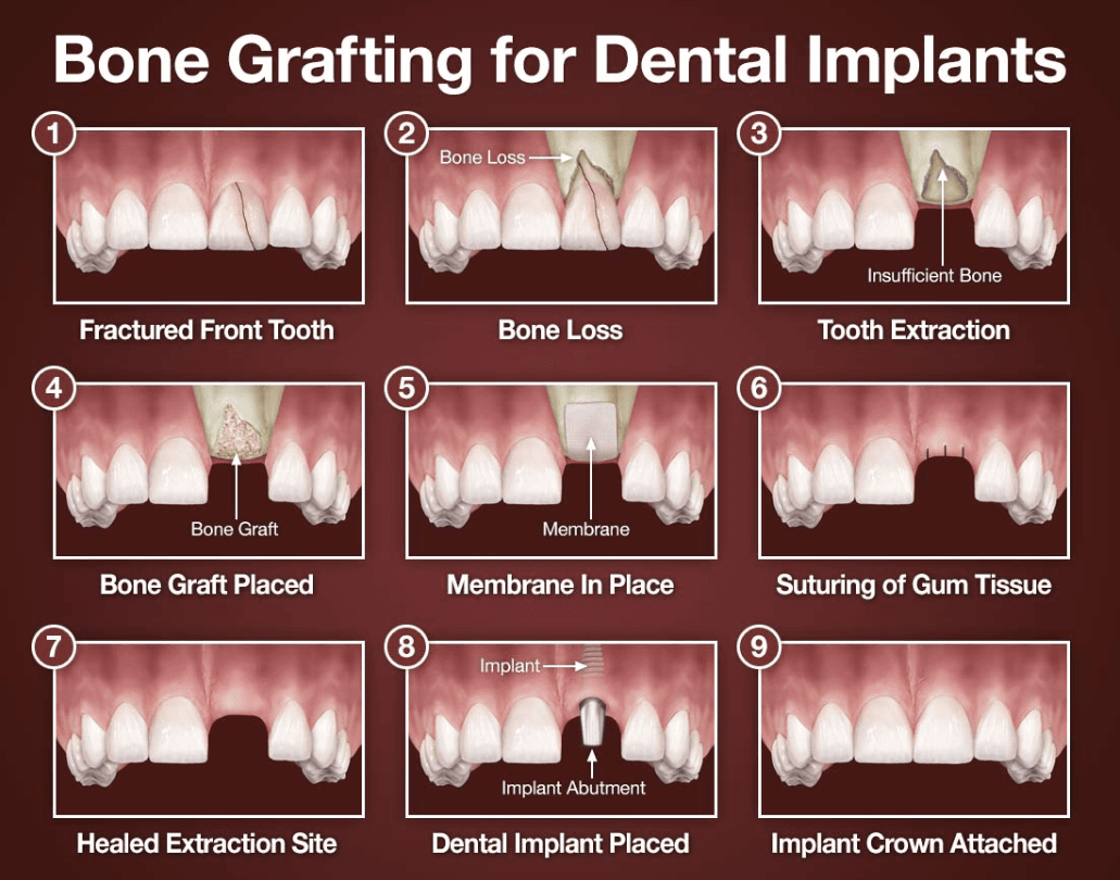 Types of Bone Grafts Types of Bone Grafts