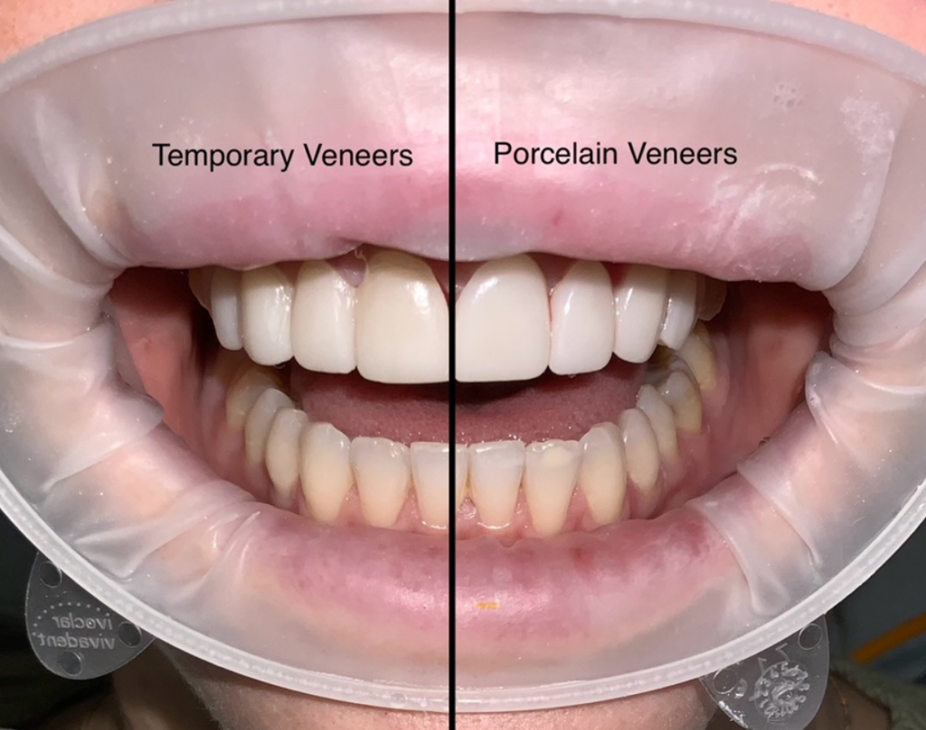 Dental Veneer Procedure Dental Veneer Procedure