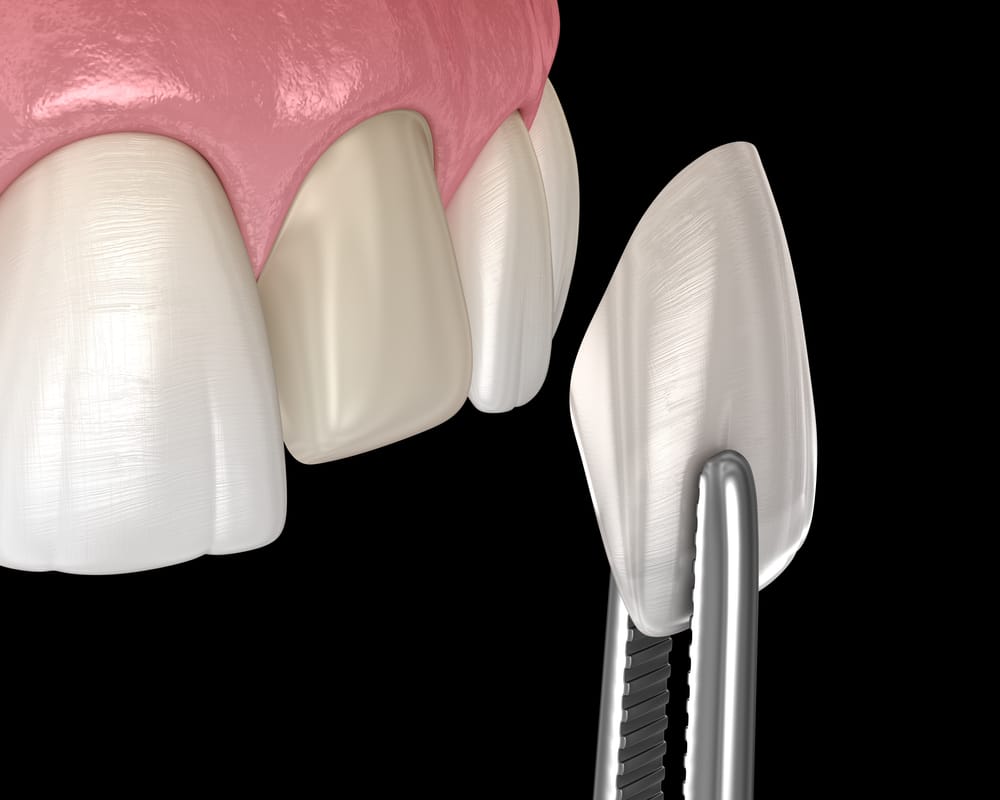 Dental,Veneer,Installation,Procedure,Over,Central,Incisor.,3d,Illustration Dental,Veneer,Installation,Procedure,Over,Central,Incisor.,3d,Illustration