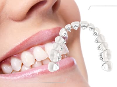 Dental Orthodontic: A Comprehensive Guide to Choosing the Best Options 11 Accelerated Orthodontics
