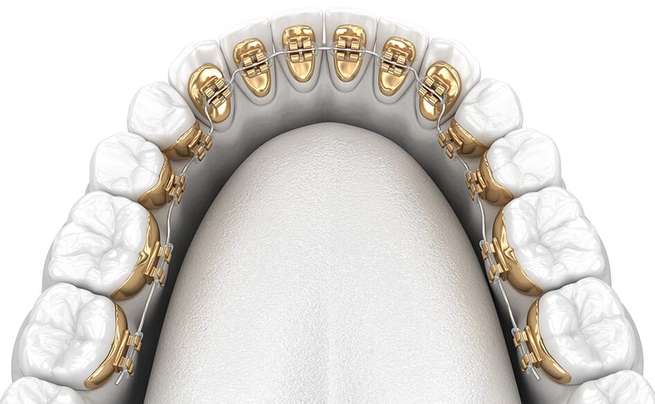 Dental Orthodontic: A Comprehensive Guide to Choosing the Best Options 9 Lingual Braces
